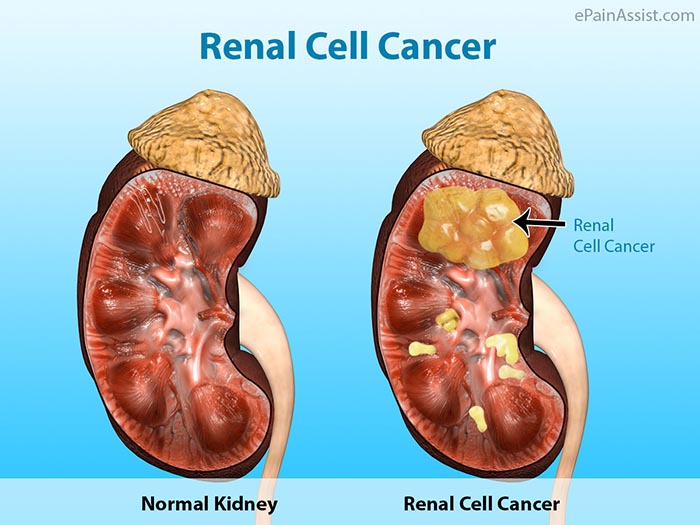 renal cell carcinoma cancer, metastatic renal cell carcinoma, kidney cancer
