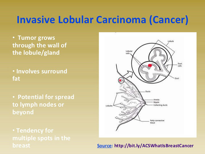 invasive lobular carcinoma, breast cancer, breast cancer treatment