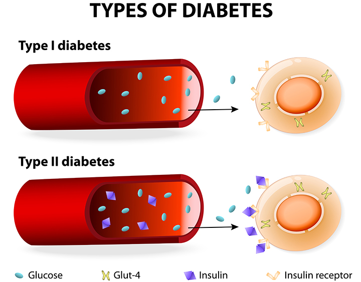 type 2 diabetes, type 2 diabetes symptoms, type 1 diabetes, difference between type 1 and type 2 diabetes