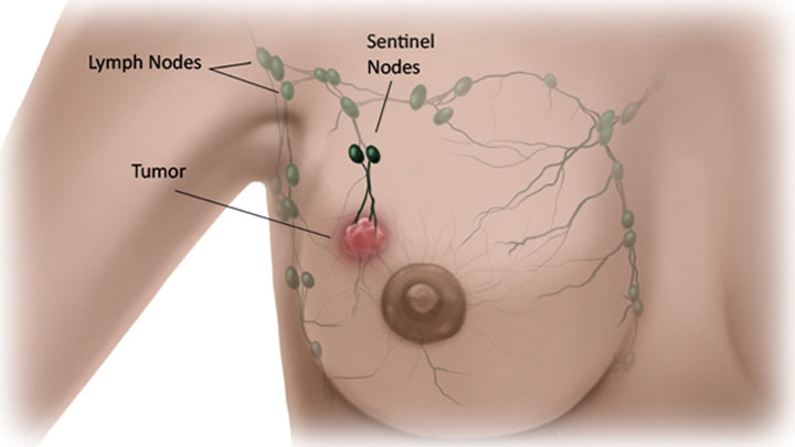 how does breast cancer spread, breast cancer, metastatic breast cancer