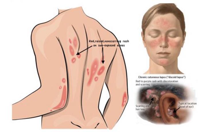 Symptoms and Signs You Have Lupus, Lupus erythematosus, 