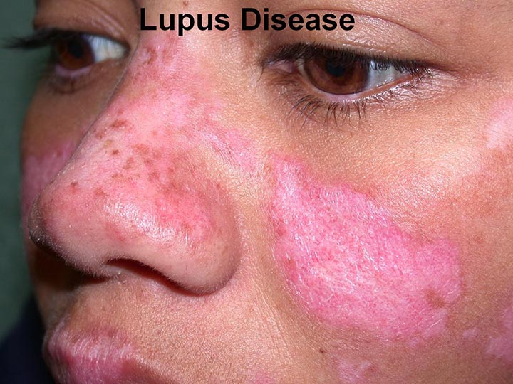 lupus symptoms, lupus rash, lupus disease, Symptoms and Signs You Have Lupus, Lupus Erythematosus