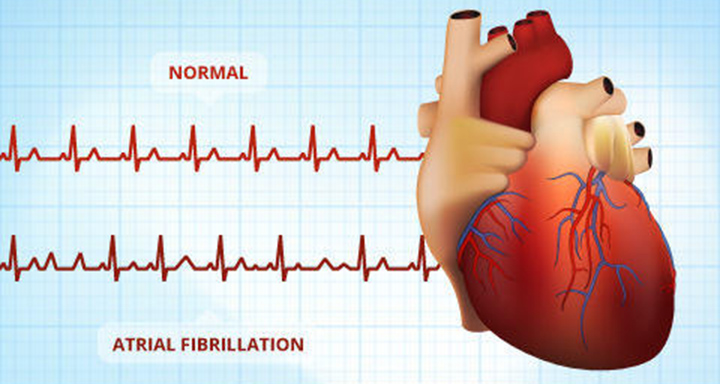 a-fib, blood thinners, stroke, afib