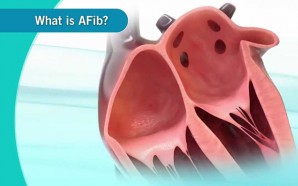 a-fib, blood thinners, stroke, afib