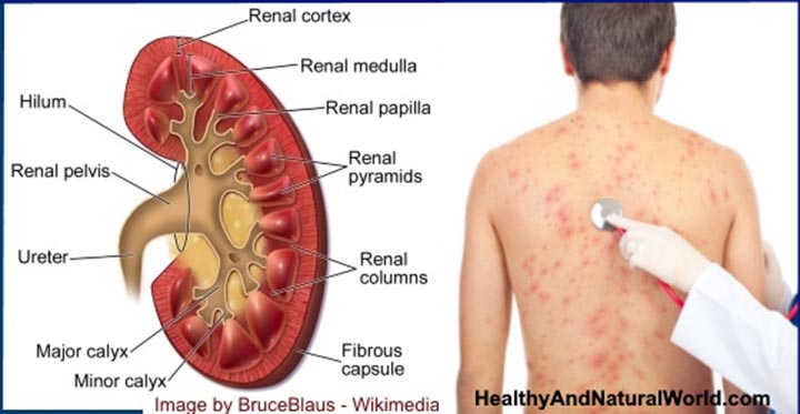 Signs and Symptoms of Kidney Failure, kidney Failure