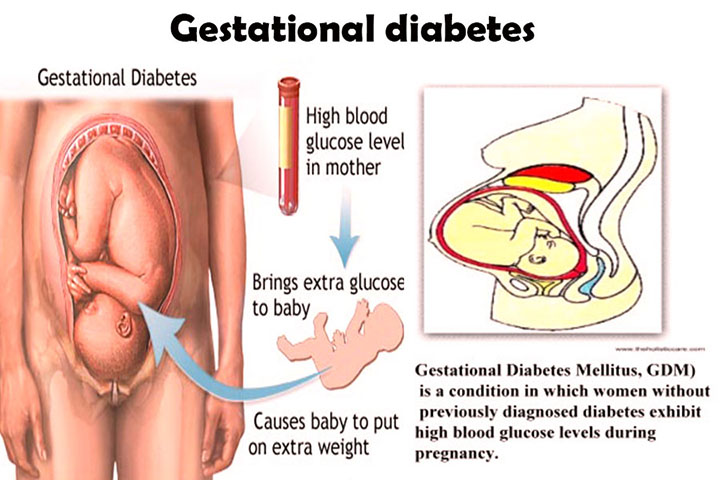 gestational diabetes, type 2 diabetes, type 2 diabetes symptoms