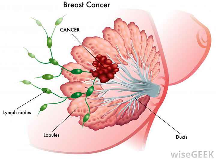 breast cancer, breast cancer treatment, types of breast cancer