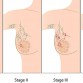 stages of breast cancer, breast cancer, breast cancer treatment, types of breast cancer
