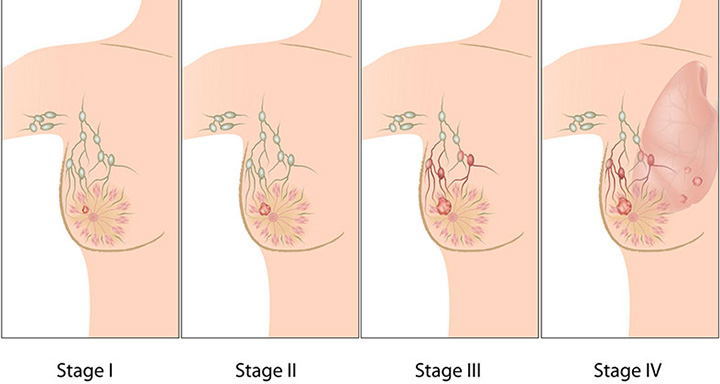 stages of breast cancer, breast cancer, breast cancer treatment, types of breast cancer
