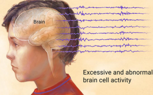 epilepsy symptoms, epilepsy, causes of epilepsy