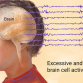 epilepsy symptoms, epilepsy, causes of epilepsy