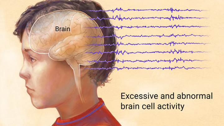 epilepsy symptoms, epilepsy, causes of epilepsy