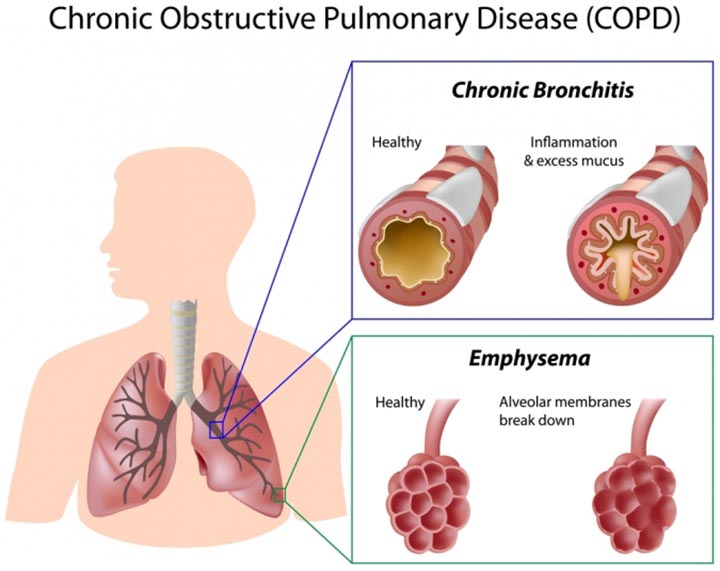 COPD, Cure for COPD, combat COPD, What is COPD