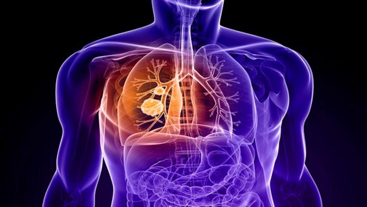 COPD, Cure for COPD, combat COPD, What is COPD
