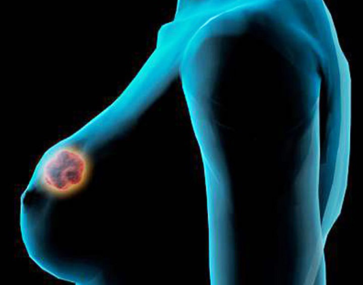 triple negative breast cancer, breast cancer, breast cancer symptoms, breast cancer treatment
