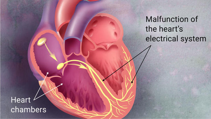 afib and stroke, stroke, afib symptoms