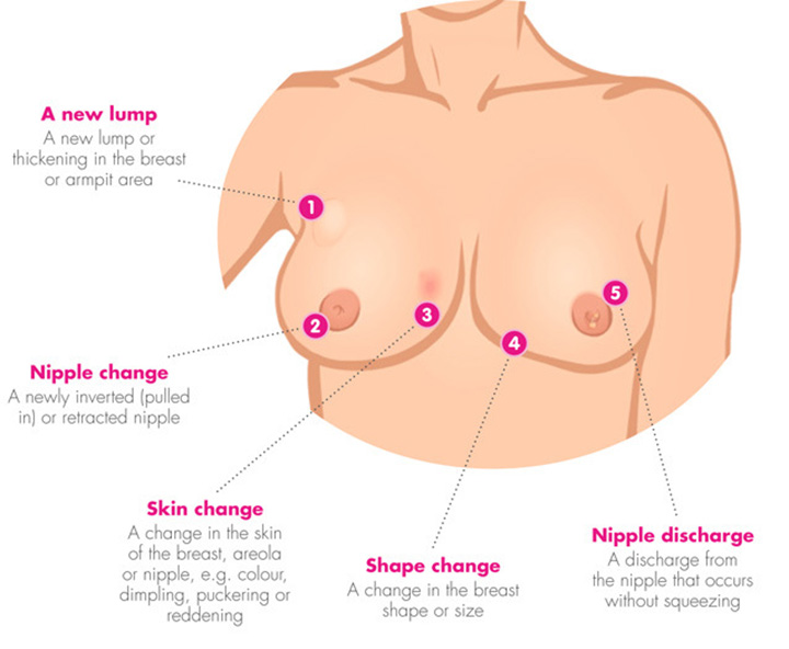 stage IV breast cancer, metastatic breast cancer, stage 4 breast cancer, stage 4 breast cancer symptoms