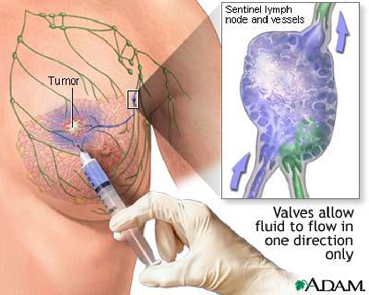 metastatic breast cancer treatment, stage 4 breast cancer treatment, advanced breast cancer