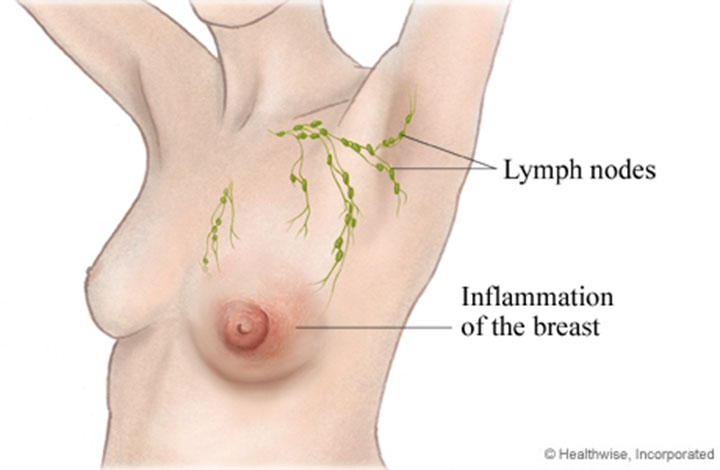 inflammatory breast cancer, breast cancer symptoms, breast cancer signs