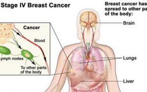 Stage 4 Breast Cancer Recurrence & Remission