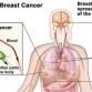 breast cancer recurrence, stage 4 breast cancer, stage 4 breast cancer treatment, metastasized breast cancer