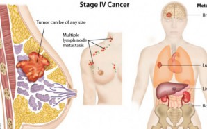 stage 4 breast cancer, metastatic breast cancer, how does breast cancer spread