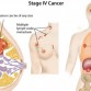stage 4 breast cancer, metastatic breast cancer, how does breast cancer spread