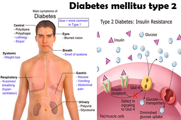 type 2 diabetes mellitus, American diabetes association, type 2 diabetes symptoms