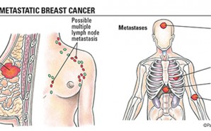 breast cancer metastasis, metastasized breast cancer, how does breast cancer spread