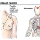 breast cancer metastasis, metastasized breast cancer, how does breast cancer spread