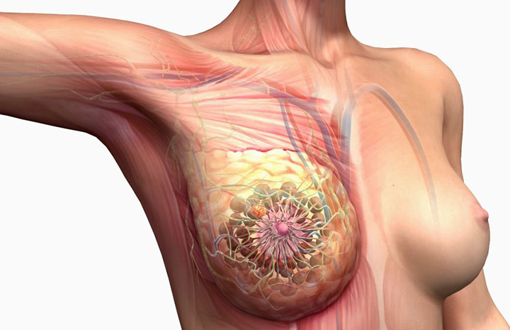 metastatic breast cancer, metastatic breast cancer treatment, metastasized breast cancer