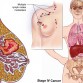metastatic breast cancer, metastatic breast cancer treatment, metastasized breast cancer