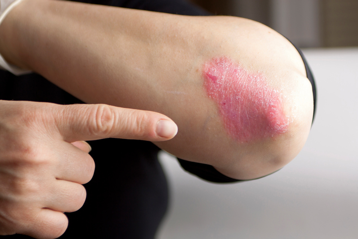 Psoriasis, plaque psoriasis