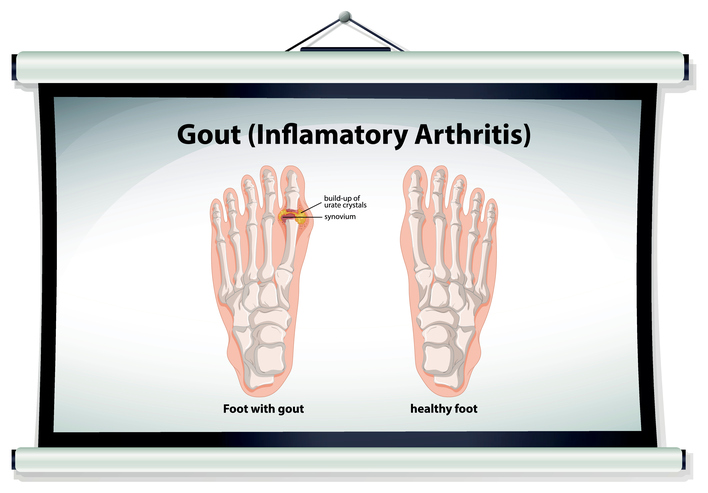 gout, gout symptoms