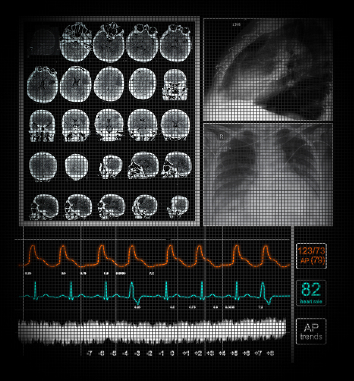 myoclonic seizures, myoclonic seizure, epilepsy, epileptic seizure