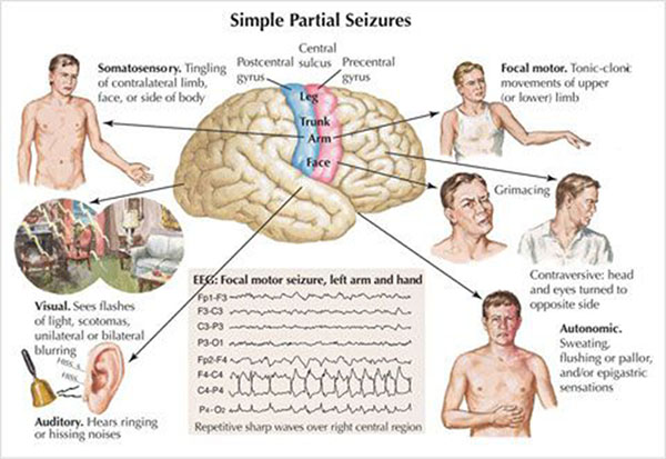 simple partial seizures, epileptic seizures