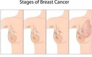 Invasive Vs Metastatic Breast Cancer