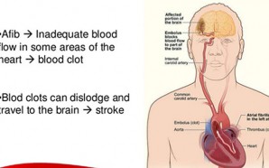 How are AFIB and Stroke Connected?