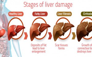 The 5 Stages of Liver Cirrhosis