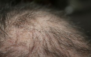 Ultimate Hair Loss Treatment Options